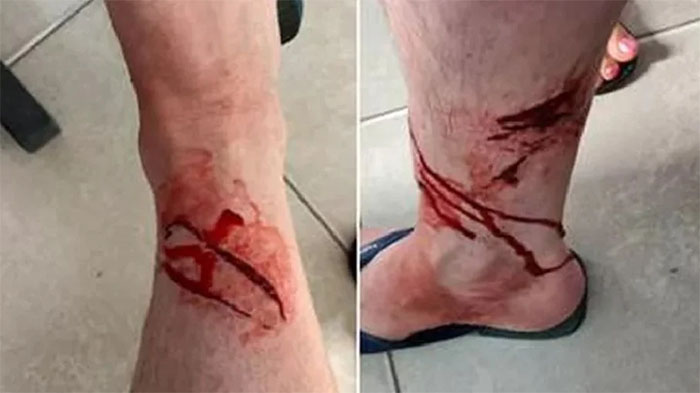 Turista francês foi atacado por tubarão em Ubatuba/SP