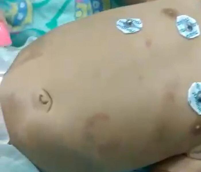 Bebê de 2 meses fica em estado grave após ser espancado pelo pai em São Fidélis/RJ