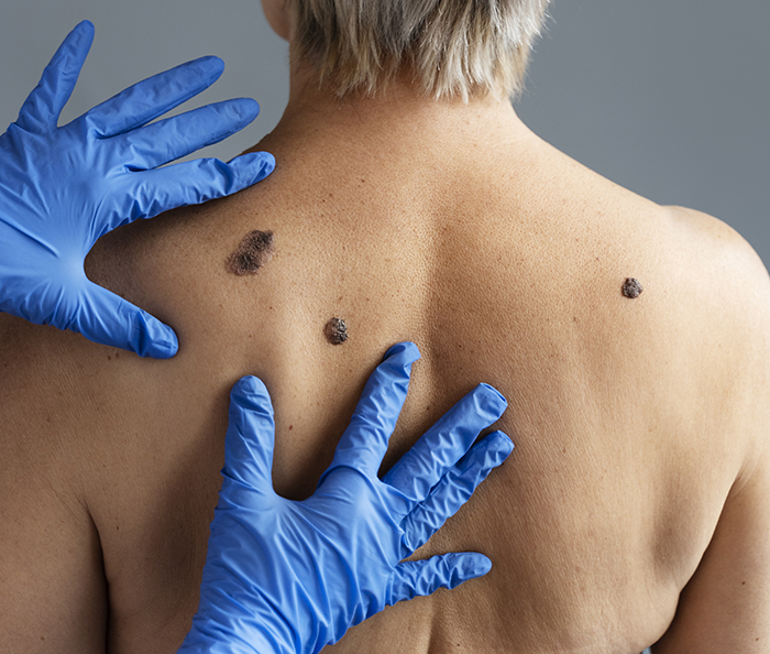 Verão alerta para prevenção do câncer de pele e o uso correto do protetor solar